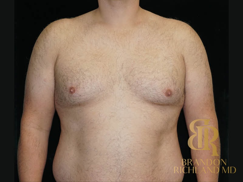 Liposuction before and after, Patient 39 — Dr. Brandon Richland, Newport Beach