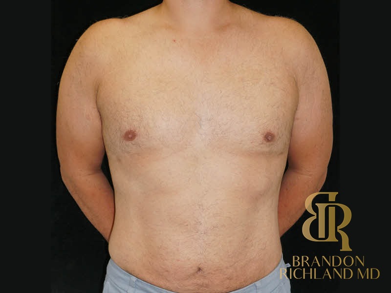 Liposuction before and after, Patient 39 — Dr. Brandon Richland, Newport Beach