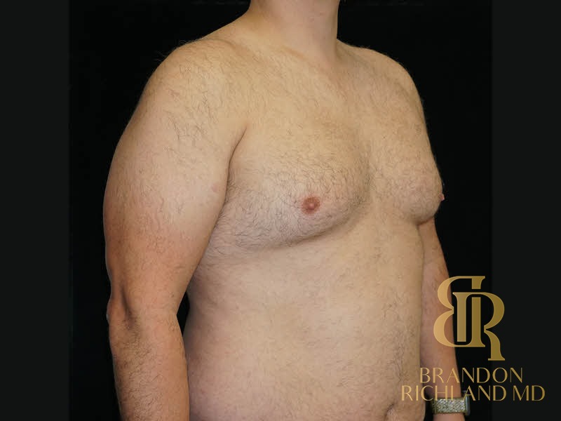 Liposuction before and after, Patient 39 — Dr. Brandon Richland, Newport Beach