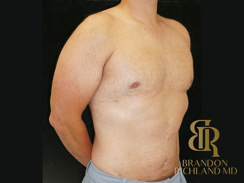 Liposuction before and after, Patient 39 — Dr. Brandon Richland, Newport Beach