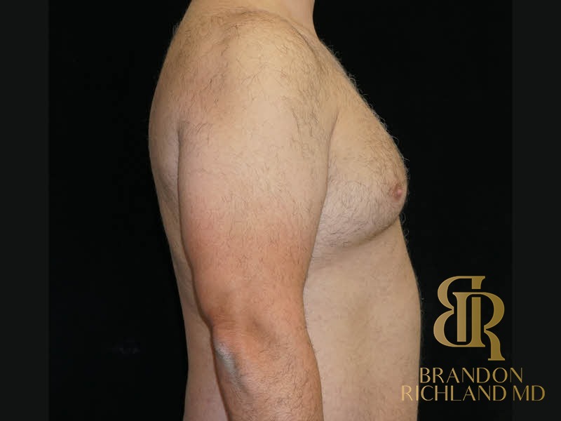 Liposuction before and after, Patient 39 — Dr. Brandon Richland, Newport Beach