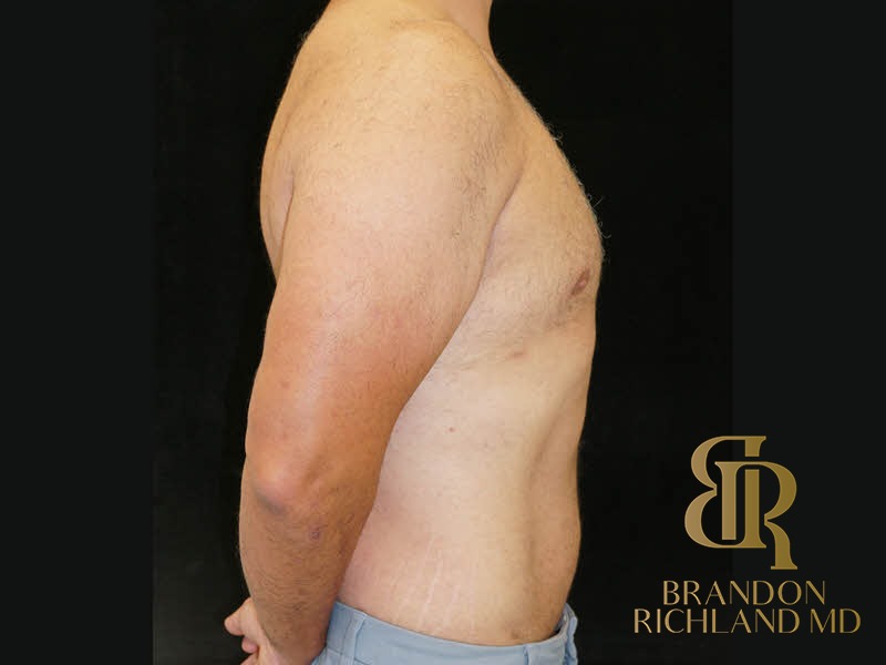 Liposuction before and after, Patient 39 — Dr. Brandon Richland, Newport Beach