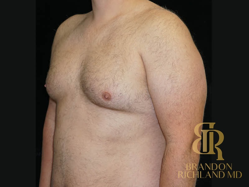 Liposuction Before, Patient 39, view 4 — Dr. Brandon Richland, Newport Beach