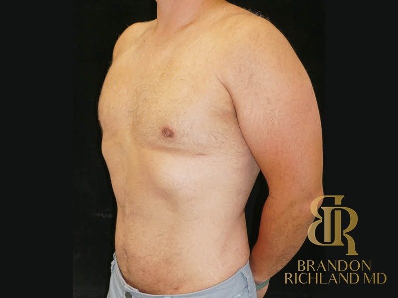 Liposuction After, Patient 39, view 4 — Dr. Brandon Richland, Newport Beach