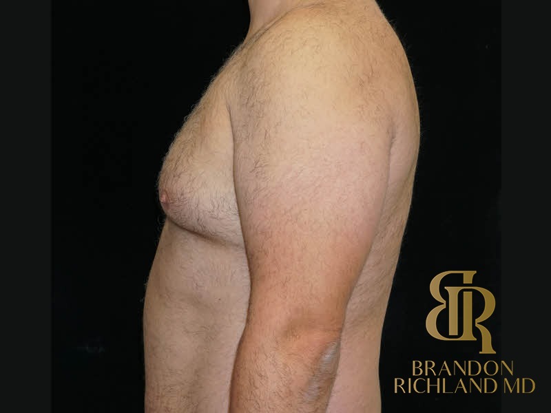 Liposuction Before, Patient 39, view 5 — Dr. Brandon Richland, Newport Beach