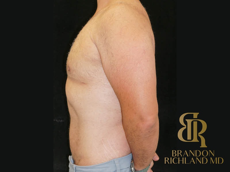 Liposuction After, Patient 39, view 5 — Dr. Brandon Richland, Newport Beach