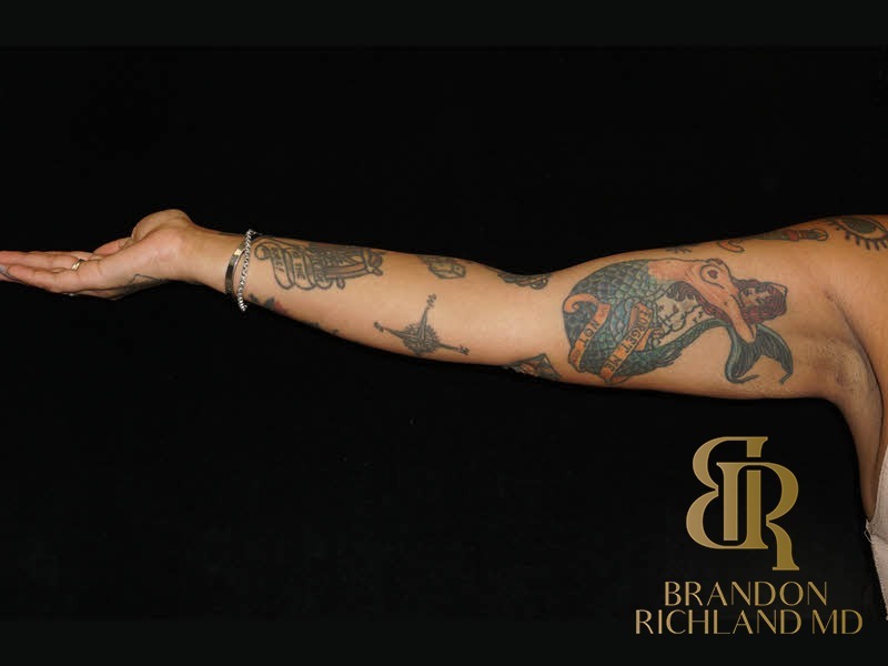 Liposuction After, Patient 41, view 7 — Dr. Brandon Richland, Newport Beach