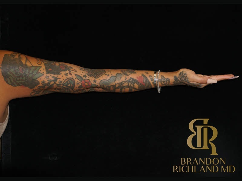 Liposuction After, Patient 41, view 10 — Dr. Brandon Richland, Newport Beach