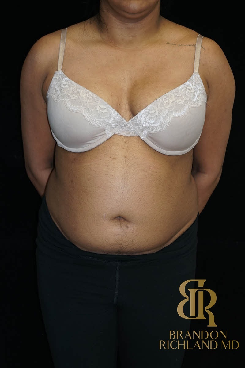 Liposuction before and after, Patient 43 — Dr. Brandon Richland, Newport Beach