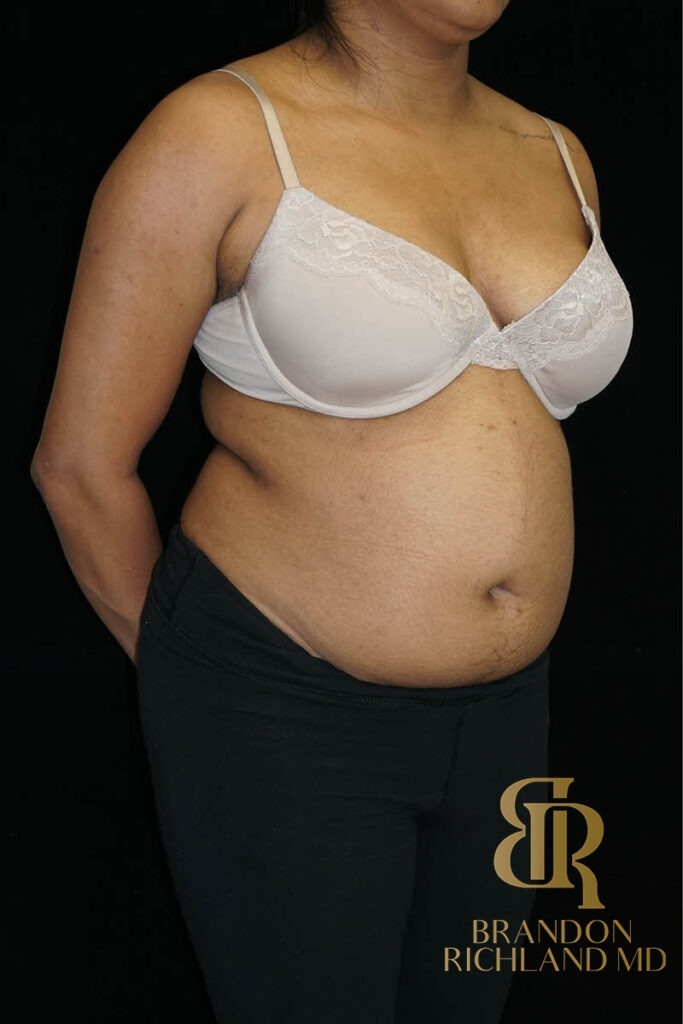 Liposuction Before, Patient 43, view 2 — Dr. Brandon Richland, Newport Beach