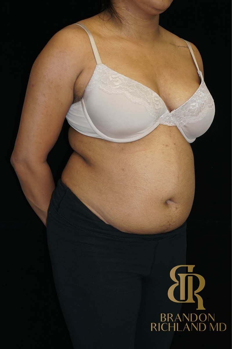 Liposuction before and after, Patient 43 — Dr. Brandon Richland, Newport Beach