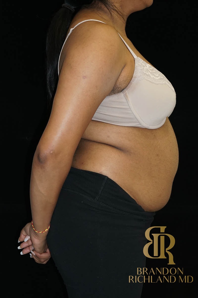 Liposuction before and after, Patient 43 — Dr. Brandon Richland, Newport Beach