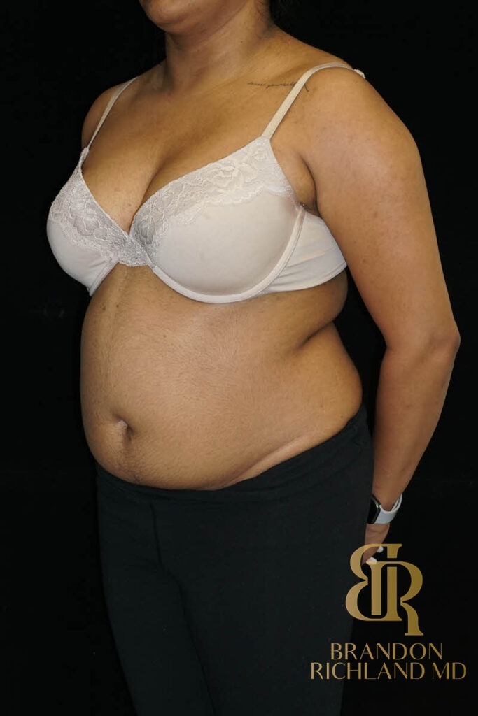 Liposuction Before, Patient 43, view 4 — Dr. Brandon Richland, Newport Beach