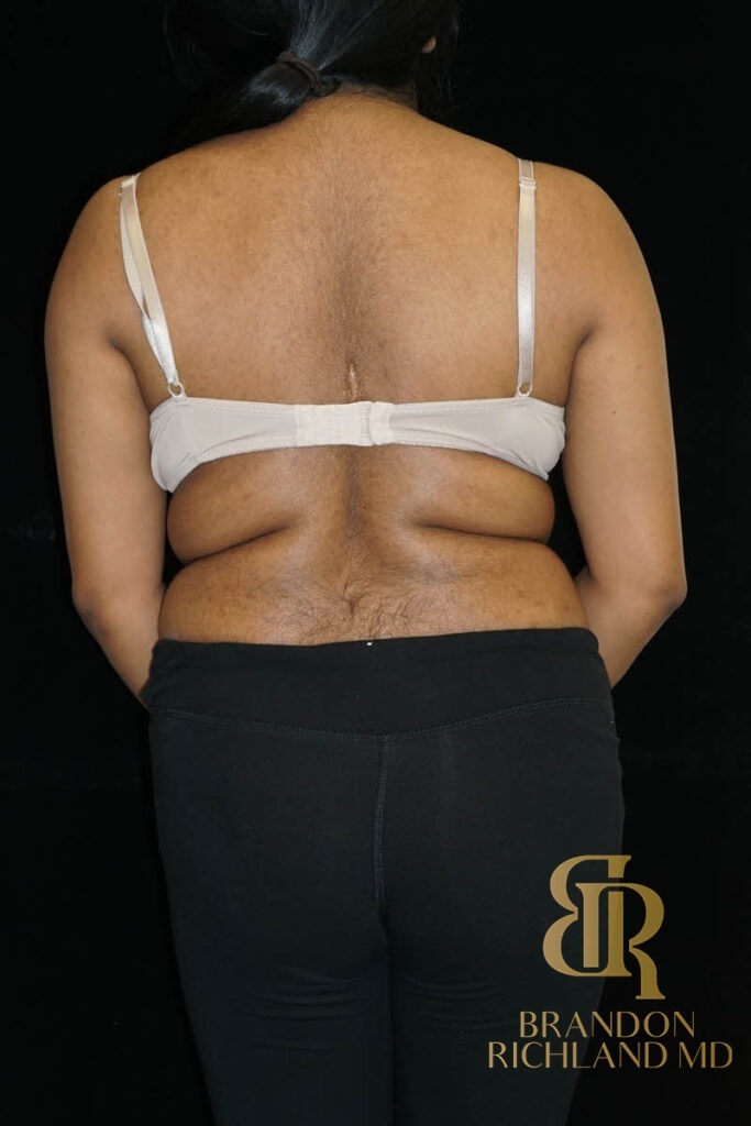 Liposuction Before, Patient 43, view 6 — Dr. Brandon Richland, Newport Beach