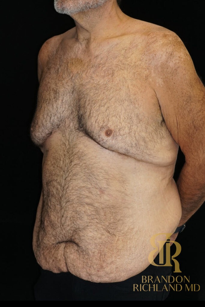 Liposuction Before, Patient 46, view 4 — Dr. Brandon Richland, Newport Beach