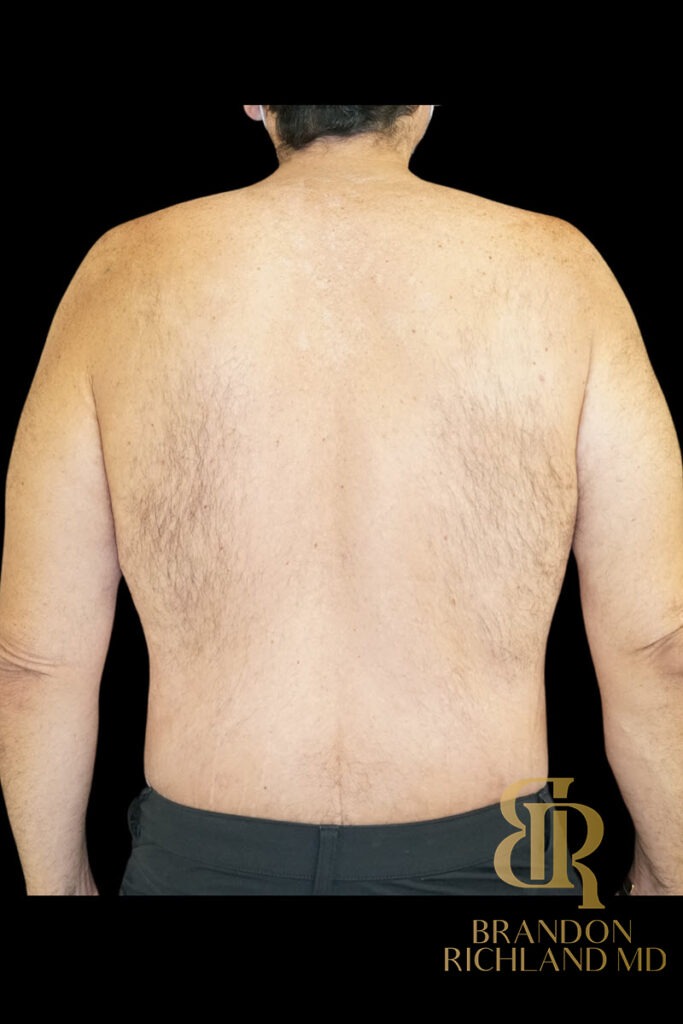 Liposuction After, Patient 46, view 6 — Dr. Brandon Richland, Newport Beach