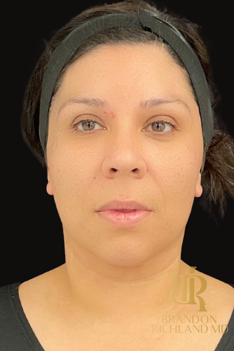 Liposuction before and after, Patient 47 — Dr. Brandon Richland, Newport Beach