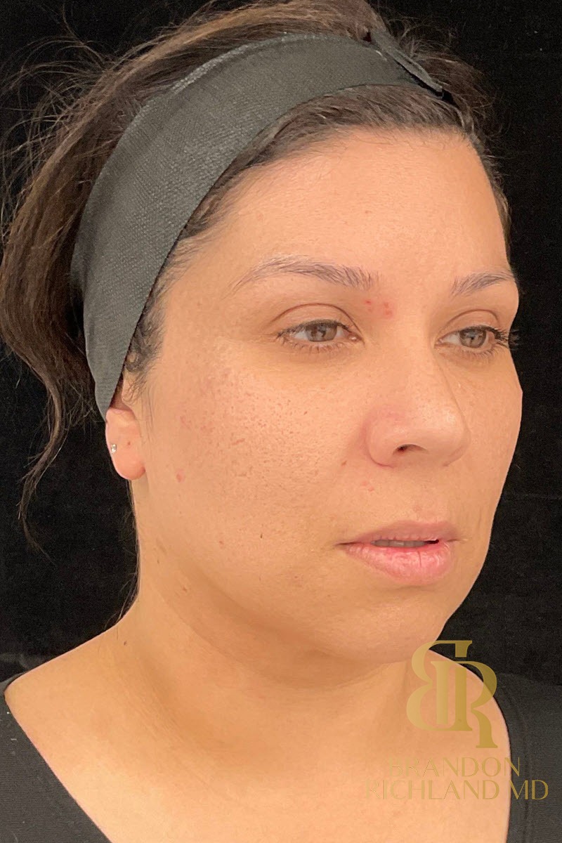 Liposuction before and after, Patient 47 — Dr. Brandon Richland, Newport Beach