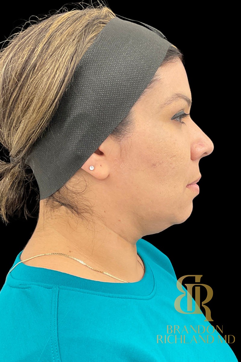 Liposuction before and after, Patient 47 — Dr. Brandon Richland, Newport Beach
