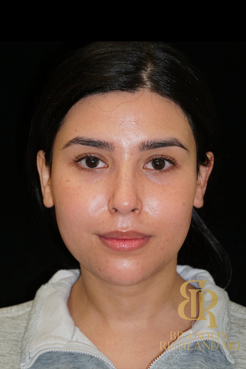 Liposuction before and after, Patient 48 — Dr. Brandon Richland, Newport Beach
