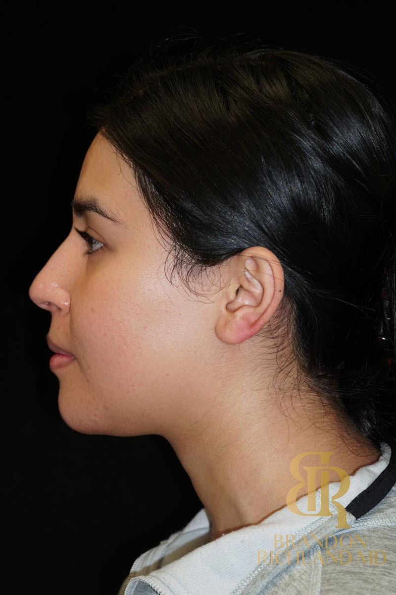 Liposuction before and after, Patient 48 — Dr. Brandon Richland, Newport Beach