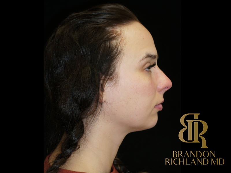 Liposuction before and after, Patient 49 — Dr. Brandon Richland, Newport Beach