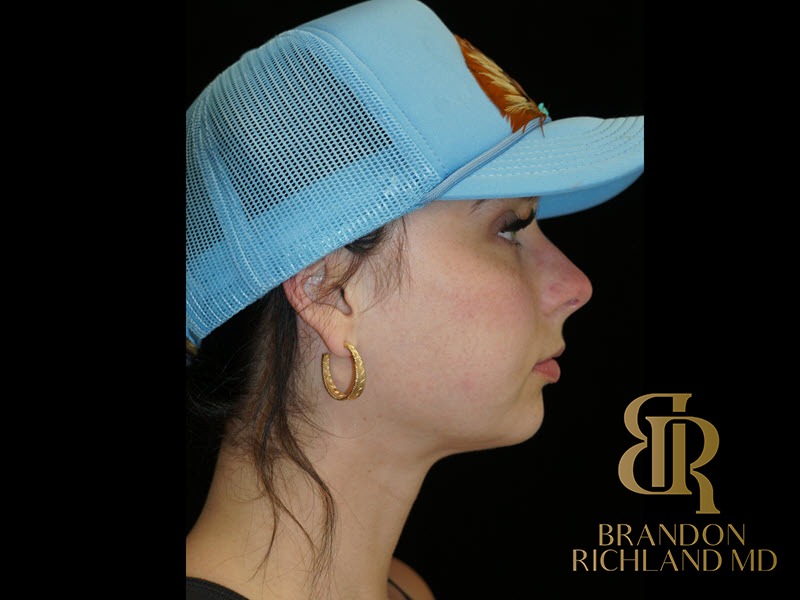 Liposuction before and after, Patient 49 — Dr. Brandon Richland, Newport Beach