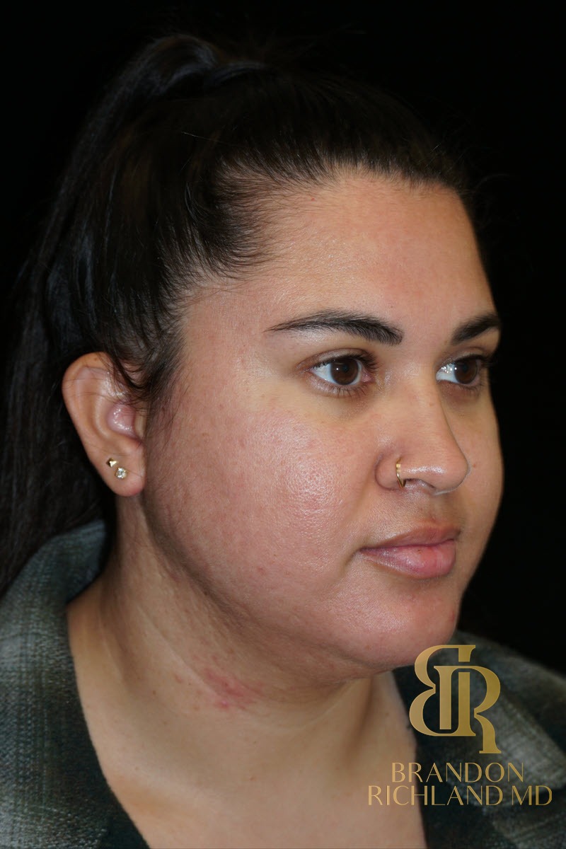 Liposuction before and after, Patient 50 — Dr. Brandon Richland, Newport Beach