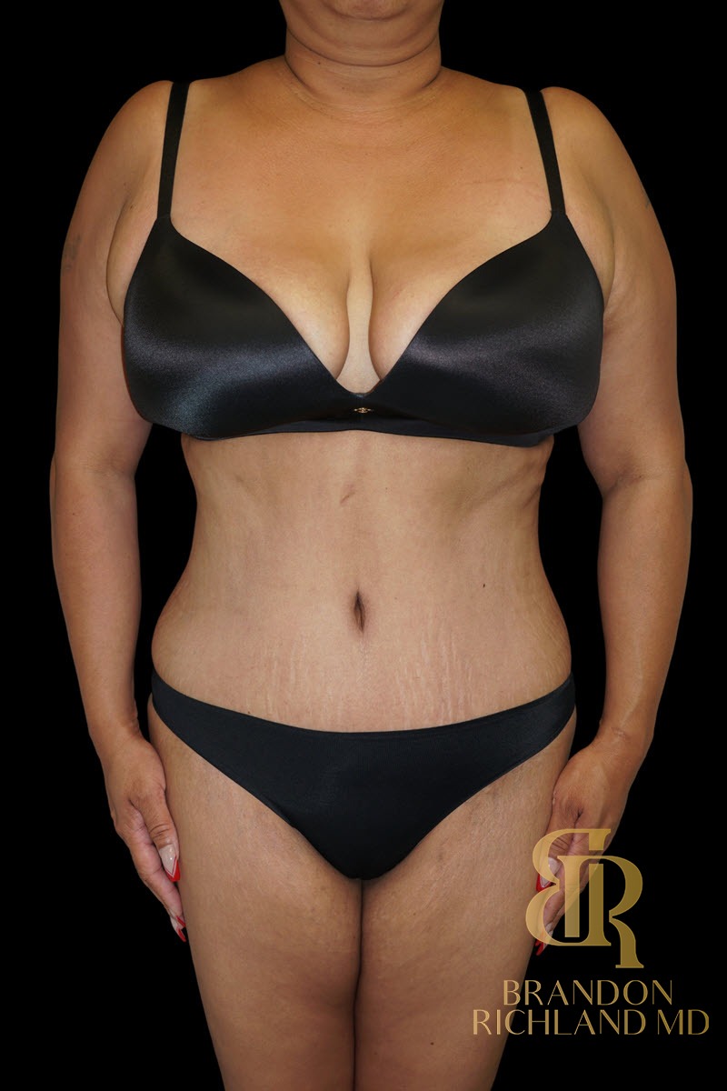 Liposuction before and after, Patient 55 — Dr. Brandon Richland, Newport Beach