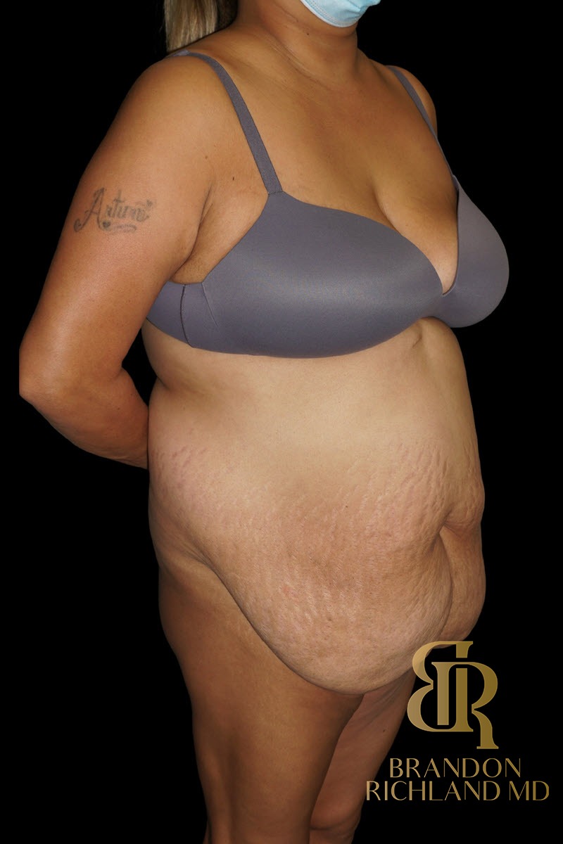 Liposuction before and after, Patient 55 — Dr. Brandon Richland, Newport Beach