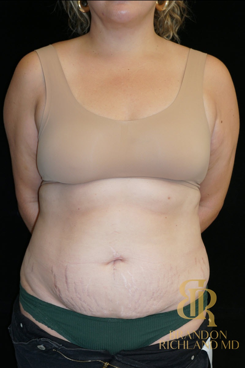 Liposuction before and after, Patient 57 — Dr. Brandon Richland, Newport Beach