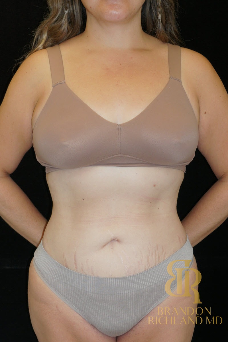 Liposuction before and after, Patient 57 — Dr. Brandon Richland, Newport Beach