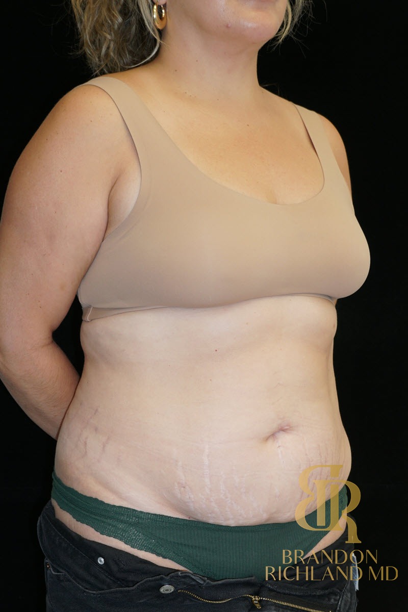 Liposuction before and after, Patient 57 — Dr. Brandon Richland, Newport Beach