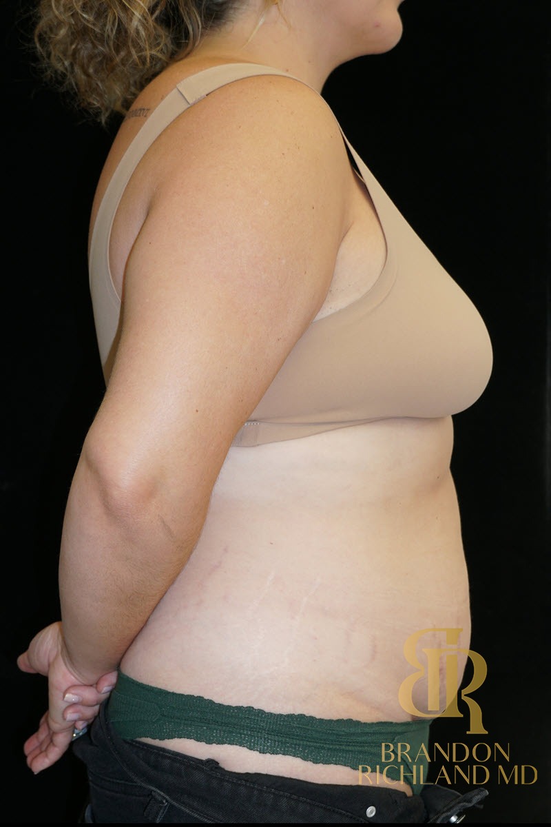Liposuction before and after, Patient 57 — Dr. Brandon Richland, Newport Beach