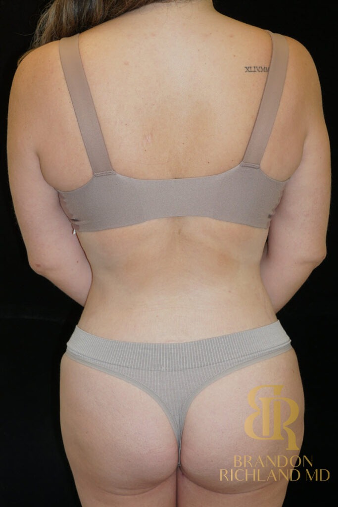 Liposuction After, Patient 57, view 6 — Dr. Brandon Richland, Newport Beach