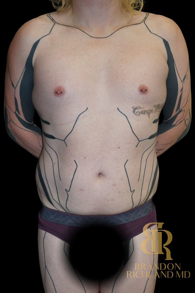 Liposuction before and after, Patient 59 — Dr. Brandon Richland, Newport Beach