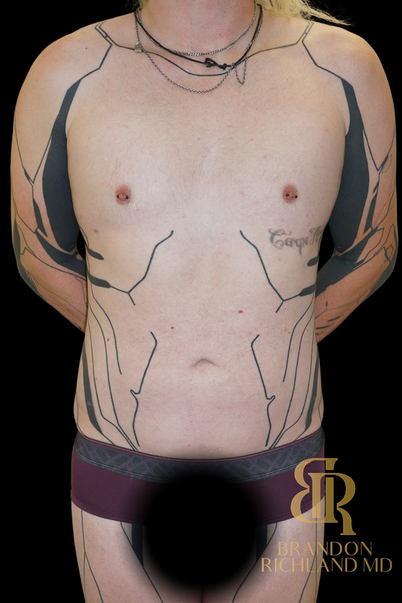 Liposuction before and after, Patient 59 — Dr. Brandon Richland, Newport Beach
