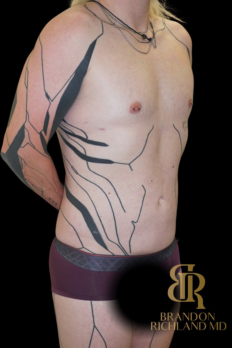 Liposuction before and after, Patient 59 — Dr. Brandon Richland, Newport Beach