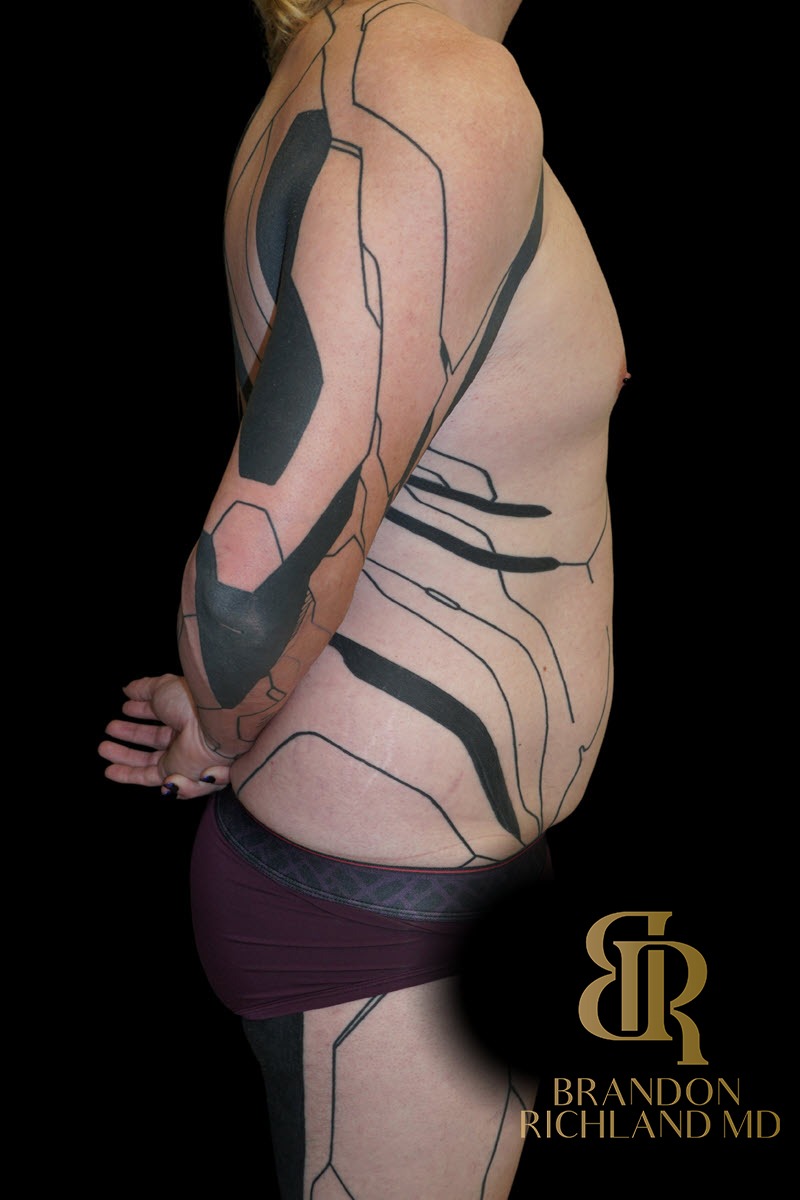 Liposuction before and after, Patient 59 — Dr. Brandon Richland, Newport Beach