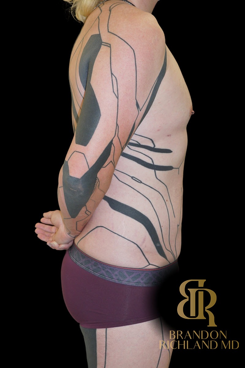 Liposuction before and after, Patient 59 — Dr. Brandon Richland, Newport Beach