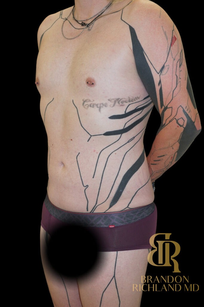 Liposuction After, Patient 59, view 4 — Dr. Brandon Richland, Newport Beach
