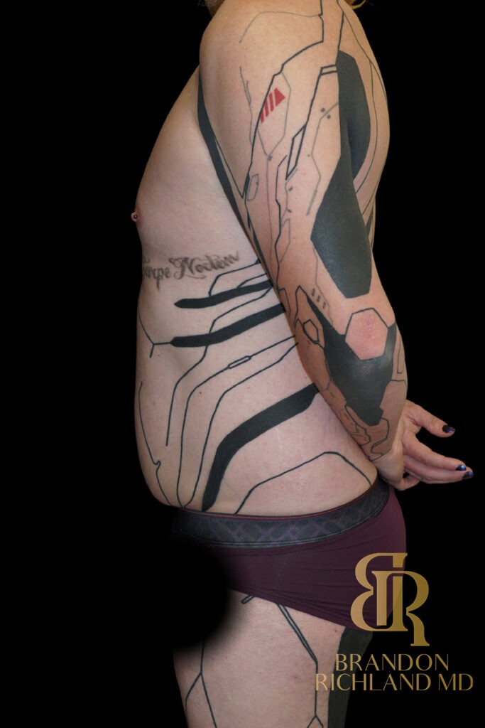 Liposuction Before, Patient 59, view 5 — Dr. Brandon Richland, Newport Beach