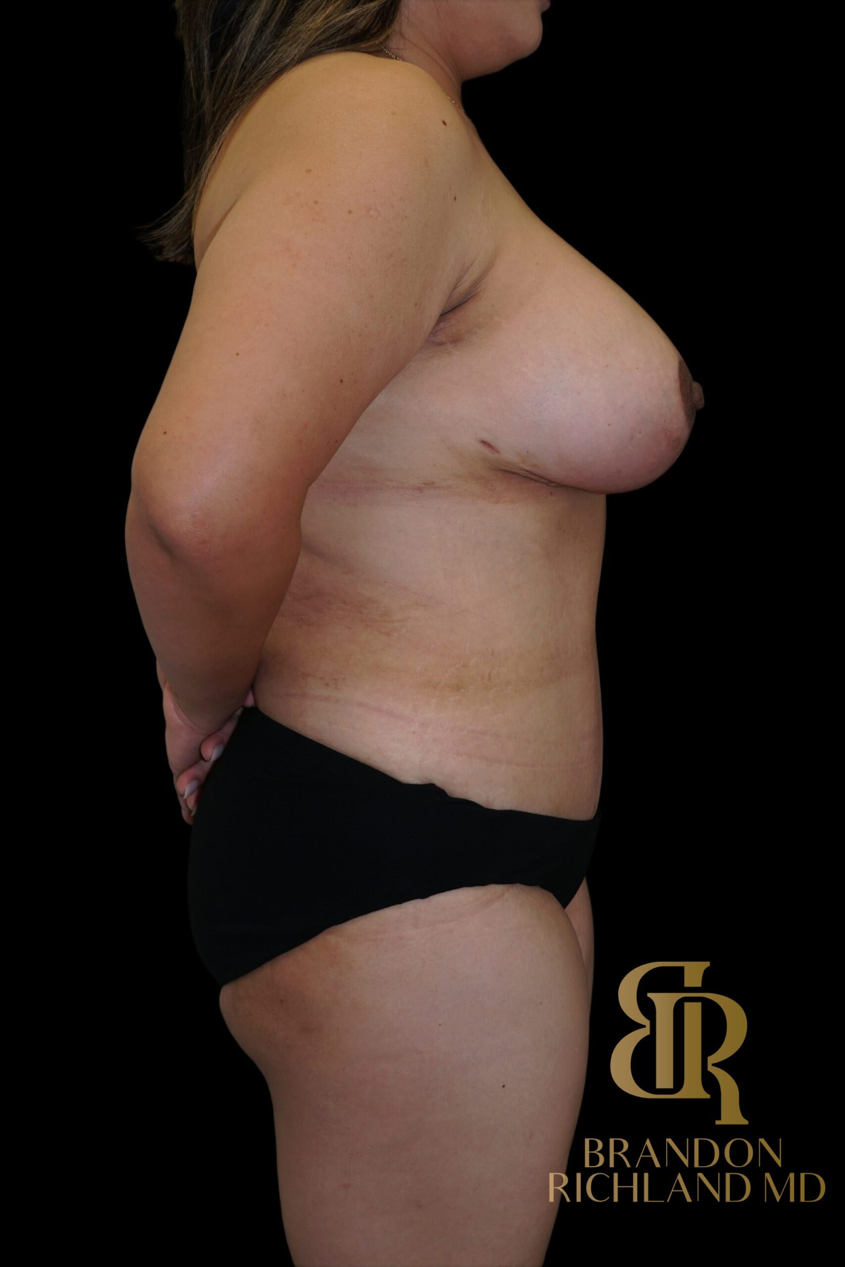 Liposuction before and after, Patient 61 — Dr. Brandon Richland, Newport Beach