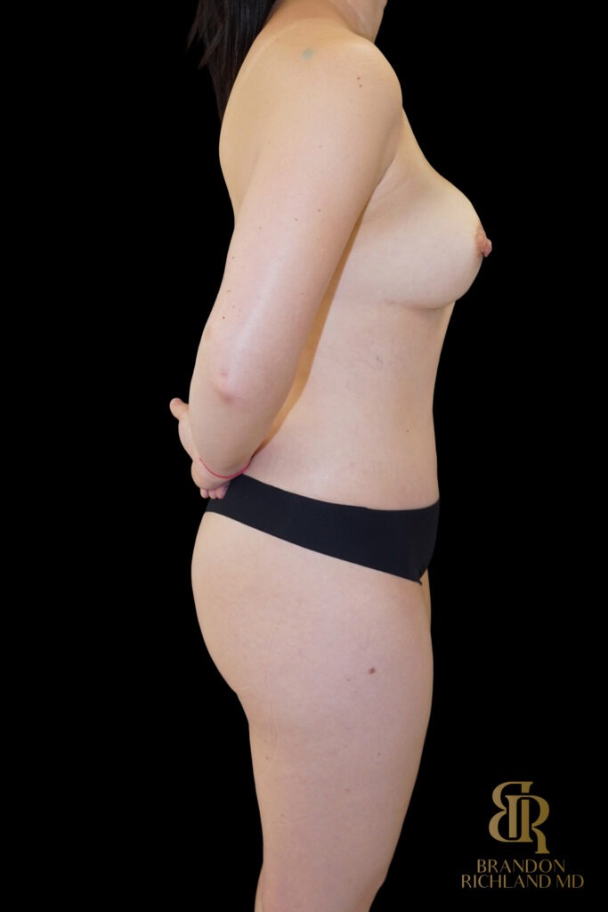 Tummy Tuck After, Case #99013, view 3 — Dr. Brandon Richland, Newport Beach