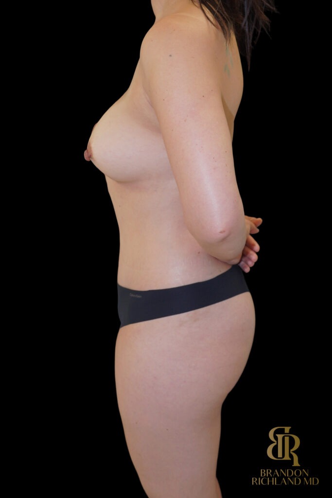 Tummy Tuck After, Case #99013, view 5 — Dr. Brandon Richland, Newport Beach