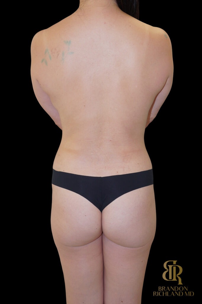 Tummy Tuck After, Case #99013, view 6 — Dr. Brandon Richland, Newport Beach