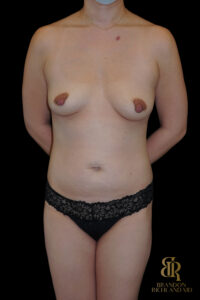 Tummy Tuck before and after, Case #99013 — Dr. Brandon Richland, Newport Beach