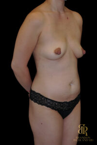 Tummy Tuck before and after, Case #99013 — Dr. Brandon Richland, Newport Beach