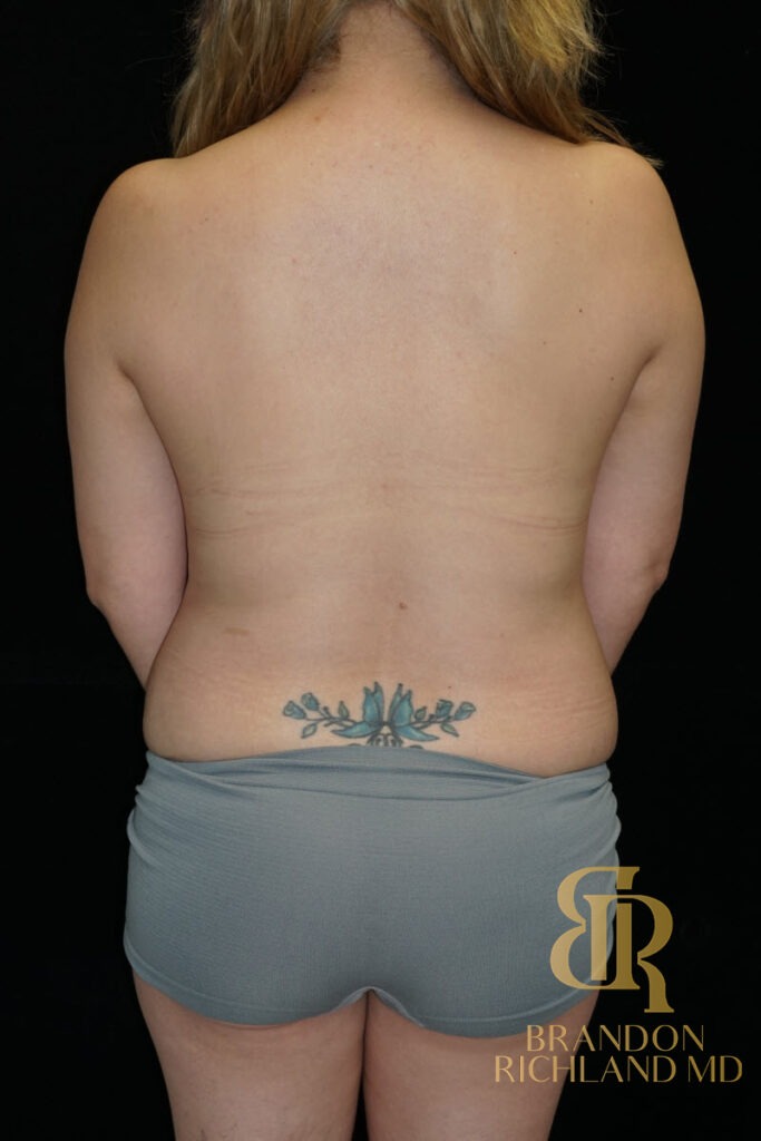 Mommy Makeover Before, Patient 11, view 6 — Dr. Brandon Richland, Newport Beach