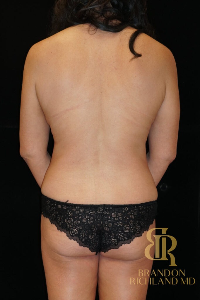 Mommy Makeover Before, Patient 13, view 6 — Dr. Brandon Richland, Newport Beach